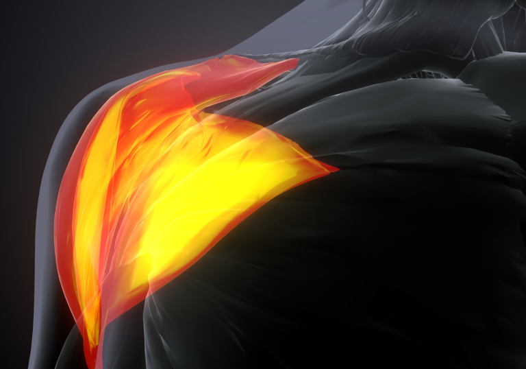 Deltoides Posterior: Los Mejores Ejercicios y Cómo Entrenarlo para un Desarrollo Completo
